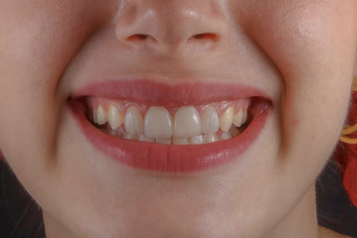 Invisalign czy Aparat Ortodontyczny: Co Wybrać?