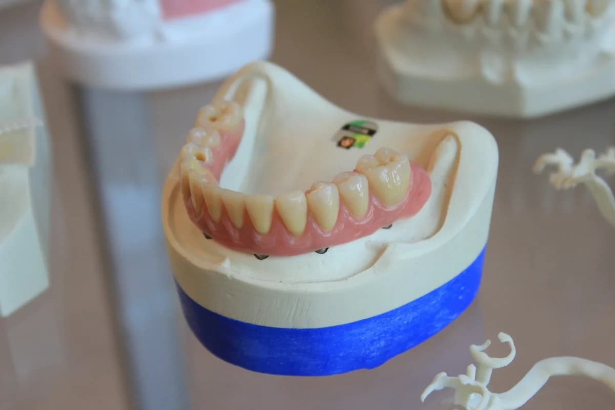 Understanding Dental Implants