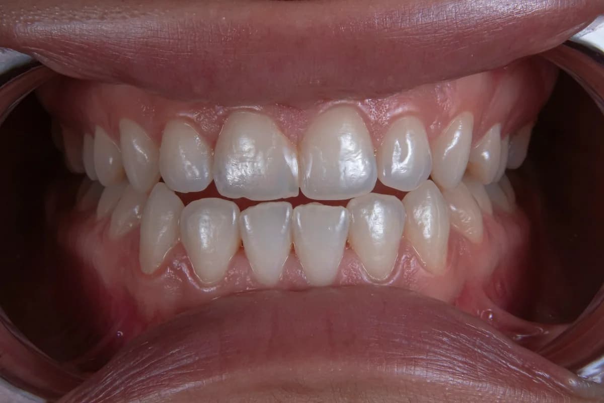 Zirconia vs PFM Front Crowns: Aesthetics and Longevity